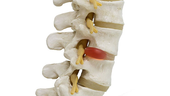 Herinated disc relief from chiropractic in Louisville