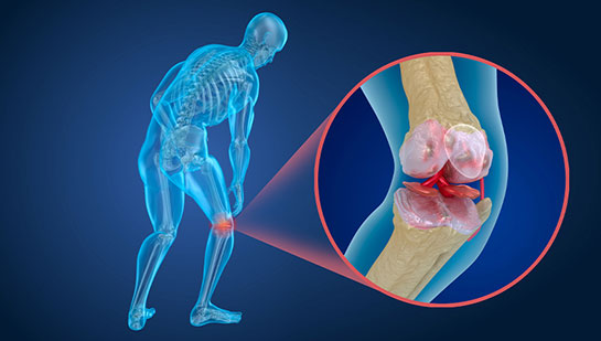 Osteoporosis treatment in Louisville